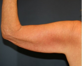 Feel Beautiful - Arm Reduction 213 - Before Photo